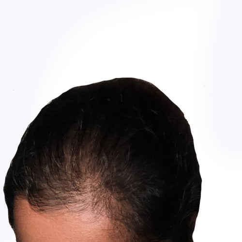 Receding Hairline